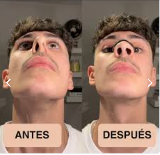 Comparación del proveedor con banda nasal